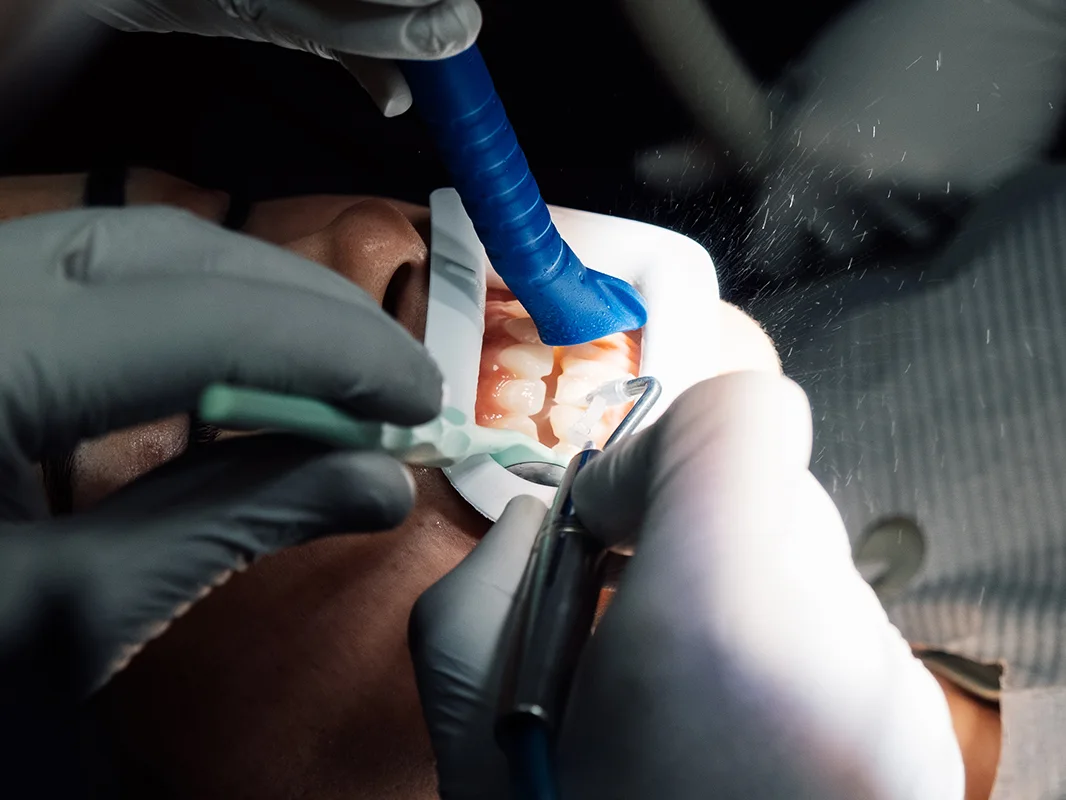 Close-up of a dental procedure at the practice