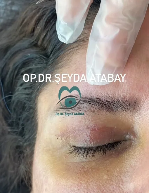Clinical procedure around the eyelid